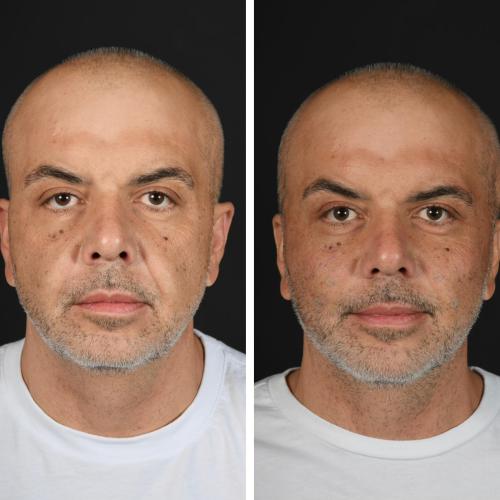 Estiramiento facial no quirúrgico Fotos del antes y el después